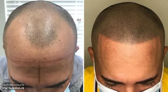 scalp micropigmentation before and after