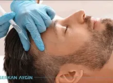 PRP Therapy for Hair Restoration