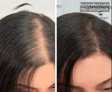 scalp micropigmentation for women